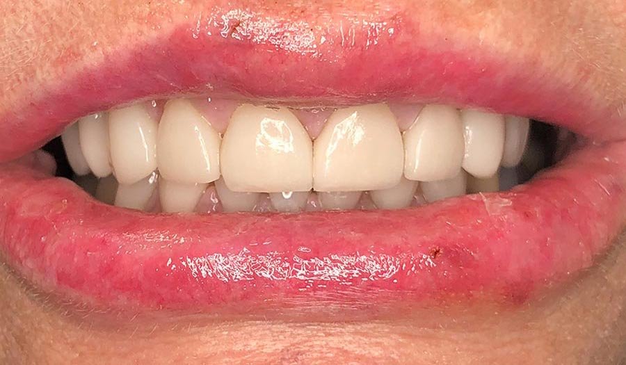 periodent-co-tijuana-dentist-dr-alejandra-gonzalez-before-after-cosmetic-dentistry-case-01-1-