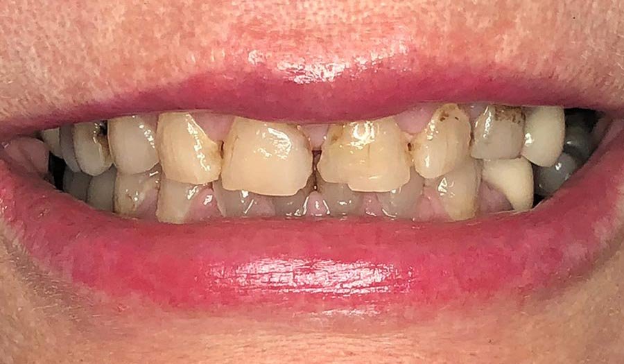 periodent-co-tijuana-dentist-dr-alejandra-gonzalez-before-after-cosmetic-dentistry-case-01-2- periodent-co-tijuana-dentist-dr-alejandra-gonzalez-before-after-cosmetic-dentistry-case-01-2-