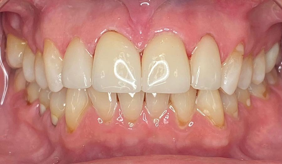 periodent-co-tijuana-dentist-dr-alejandra-gonzalez-before-after-cosmetic-dentistry-case-02-1