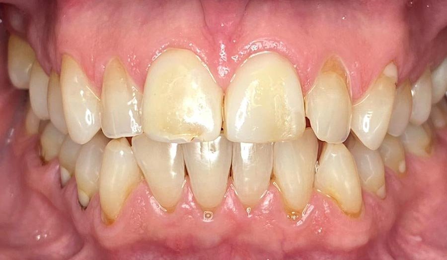 periodent-co-tijuana-dentist-dr-alejandra-gonzalez-before-after-cosmetic-dentistry-case-02-2 periodent-co-tijuana-dentist-dr-alejandra-gonzalez-before-after-cosmetic-dentistry-case-02-2