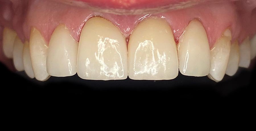 periodent-co-tijuana-dentist-dr-alejandra-gonzalez-before-after-cosmetic-dentistry-case-02-3