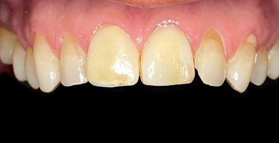 periodent-co-tijuana-dentist-dr-alejandra-gonzalez-before-after-cosmetic-dentistry-case-02-4 periodent-co-tijuana-dentist-dr-alejandra-gonzalez-before-after-cosmetic-dentistry-case-02-4