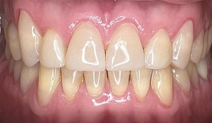 periodent-co-tijuana-dentist-dr-alejandra-gonzalez-before-after-cosmetic-dentistry-case-03-1