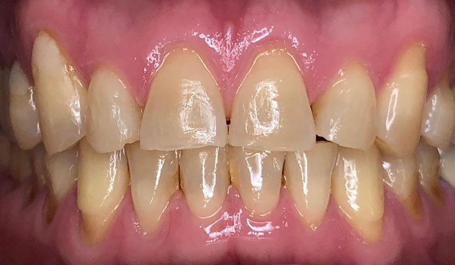 periodent-co-tijuana-dentist-dr-alejandra-gonzalez-before-after-cosmetic-dentistry-case-03-2 periodent-co-tijuana-dentist-dr-alejandra-gonzalez-before-after-cosmetic-dentistry-case-03-2