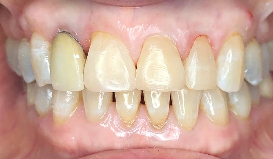 periodent-co-tijuana-dentist-dr-alejandra-gonzalez-before-after-cosmetic-dentistry-case-04-1