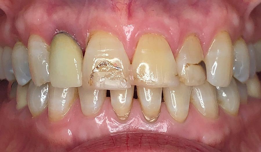 periodent-co-tijuana-dentist-dr-alejandra-gonzalez-before-after-cosmetic-dentistry-case-04-2 periodent-co-tijuana-dentist-dr-alejandra-gonzalez-before-after-cosmetic-dentistry-case-04-2