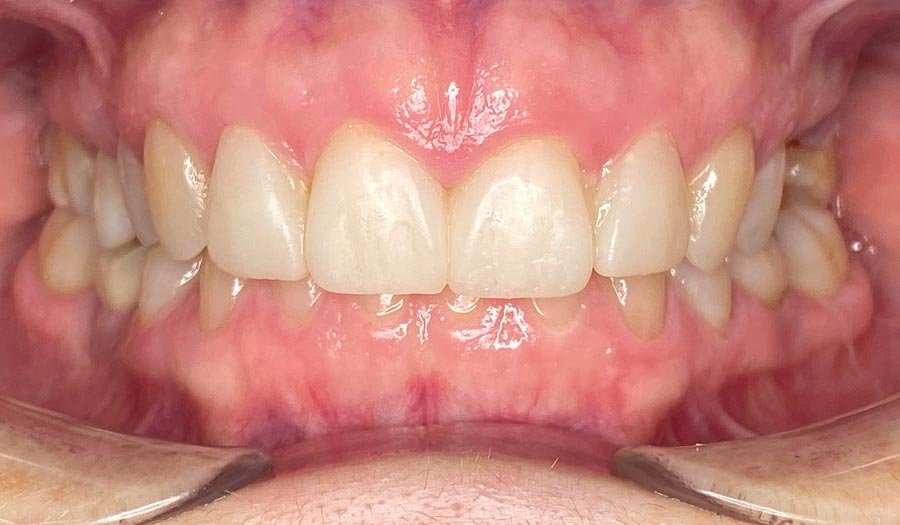 periodent-co-tijuana-dentist-dr-alejandra-gonzalez-before-after-cosmetic-dentistry-case-05-1