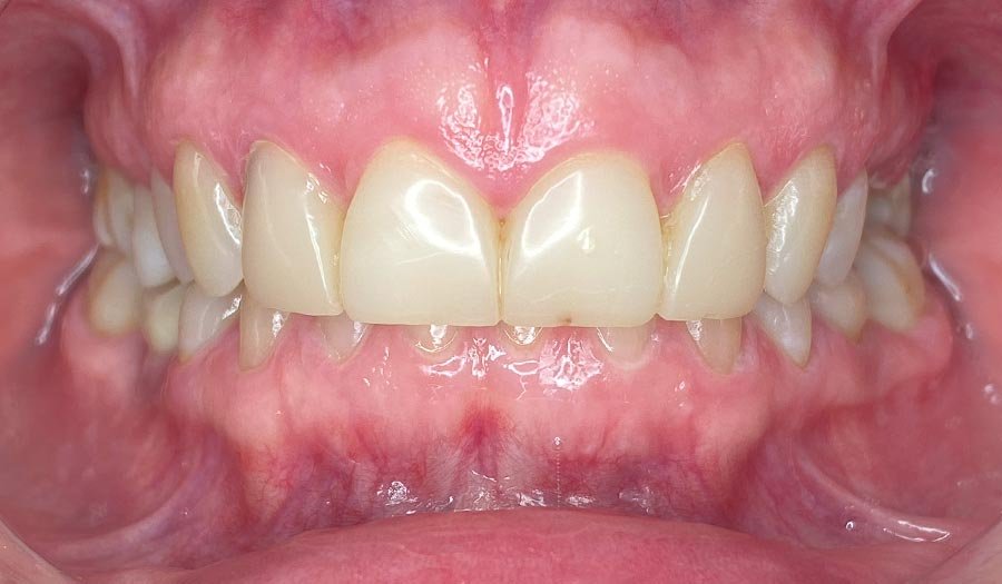 periodent-co-tijuana-dentist-dr-alejandra-gonzalez-before-after-cosmetic-dentistry-case-05-2 periodent-co-tijuana-dentist-dr-alejandra-gonzalez-before-after-cosmetic-dentistry-case-05-2