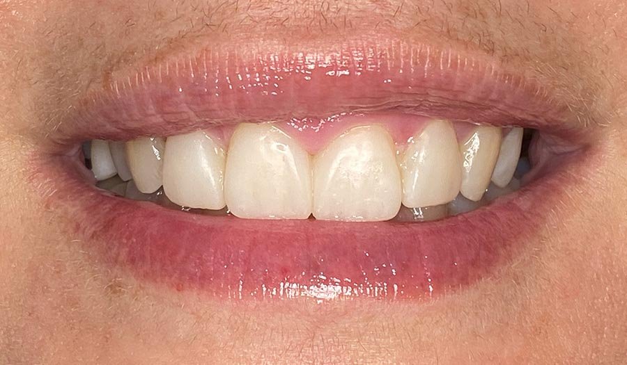 periodent-co-tijuana-dentist-dr-alejandra-gonzalez-before-after-cosmetic-dentistry-case-05-3