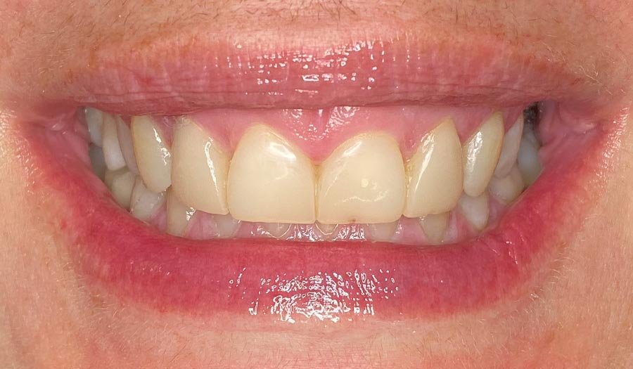 periodent-co-tijuana-dentist-dr-alejandra-gonzalez-before-after-cosmetic-dentistry-case-05-4 periodent-co-tijuana-dentist-dr-alejandra-gonzalez-before-after-cosmetic-dentistry-case-05-4