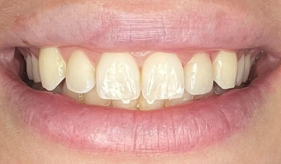 periodent-co-tijuana-dentist-dr-alejandra-gonzalez-before-after-cosmetic-dentistry-case-06-1