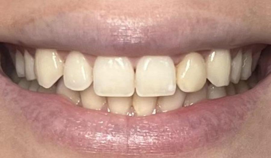 periodent-co-tijuana-dentist-dr-alejandra-gonzalez-before-after-cosmetic-dentistry-case-06-2 periodent-co-tijuana-dentist-dr-alejandra-gonzalez-before-after-cosmetic-dentistry-case-06-2