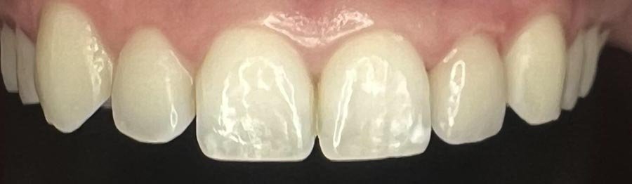 periodent-co-tijuana-dentist-dr-alejandra-gonzalez-before-after-cosmetic-dentistry-case-06-3