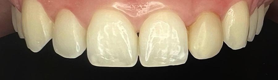 periodent-co-tijuana-dentist-dr-alejandra-gonzalez-before-after-cosmetic-dentistry-case-06-4 periodent-co-tijuana-dentist-dr-alejandra-gonzalez-before-after-cosmetic-dentistry-case-06-4
