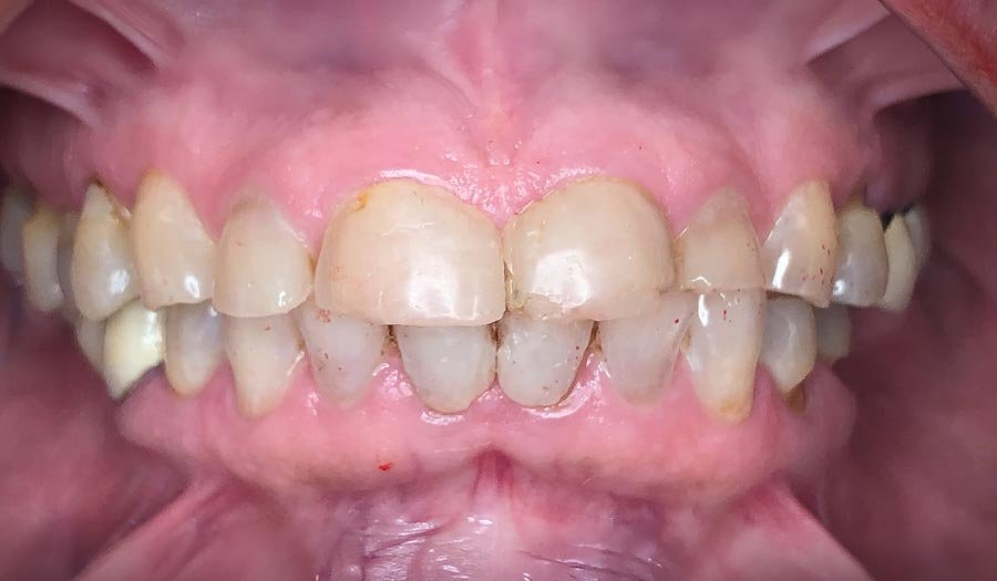 periodent-co-tijuana-dentist-dr-alejandra-gonzalez-before-after-cosmetic-dentistry-case-07-1 periodent-co-tijuana-dentist-dr-alejandra-gonzalez-before-after-cosmetic-dentistry-case-07-1
