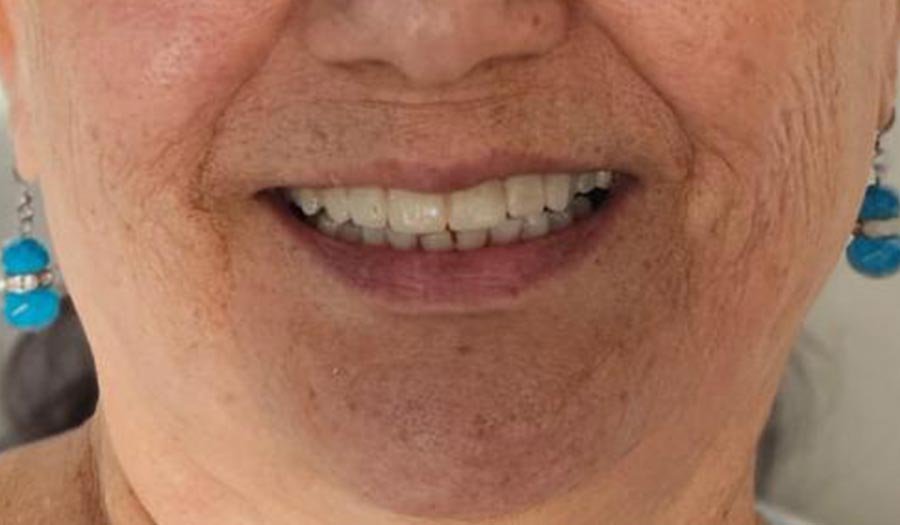 periodent-co-tijuana-dentist-dr-alejandra-gonzalez-before-after-cosmetic-dentistry-case-07-2