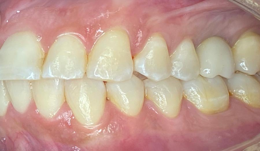 periodent-co-tijuana-dentist-dr-alejandra-gonzalez-before-after-dental-implant-case-01-1 periodent-co-tijuana-dentist-dr-alejandra-gonzalez-before-after-dental-implant-case-01-1