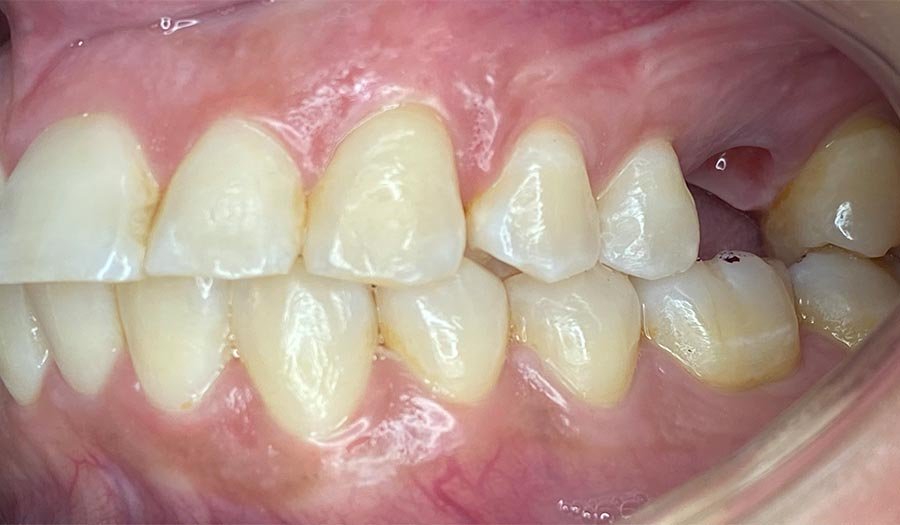 periodent-co-tijuana-dentist-dr-alejandra-gonzalez-before-after-dental-implant-case-01-2