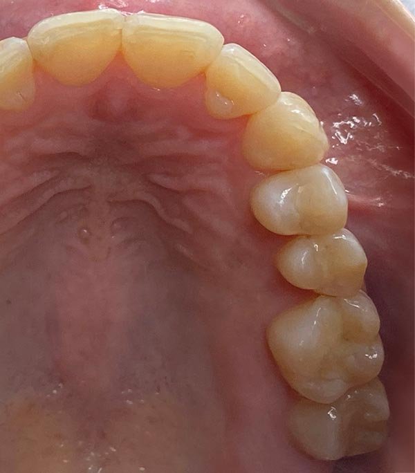 periodent-co-tijuana-dentist-dr-alejandra-gonzalez-before-after-dental-implant-case-01-3 periodent-co-tijuana-dentist-dr-alejandra-gonzalez-before-after-dental-implant-case-01-3
