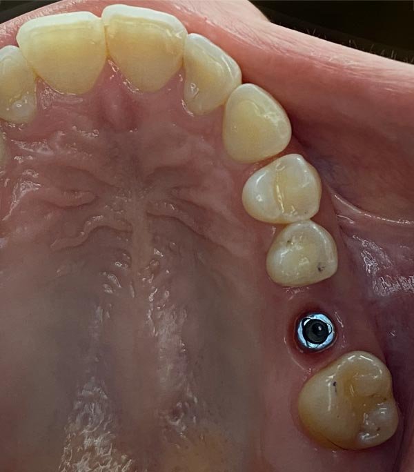 periodent-co-tijuana-dentist-dr-alejandra-gonzalez-before-after-dental-implant-case-01-4