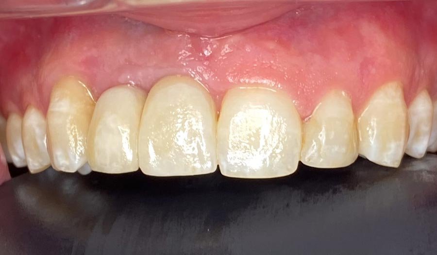 periodent-co-tijuana-dentist-dr-alejandra-gonzalez-before-after-dental-implant-case-02-1