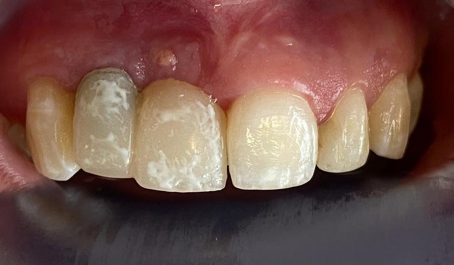 periodent-co-tijuana-dentist-dr-alejandra-gonzalez-before-after-dental-implant-case-02-2 periodent-co-tijuana-dentist-dr-alejandra-gonzalez-before-after-dental-implant-case-02-2