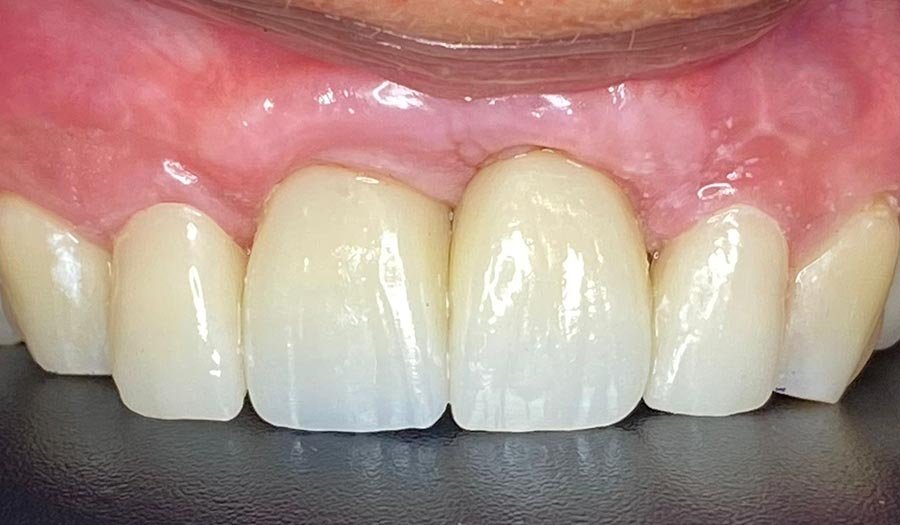 periodent-co-tijuana-dentist-dr-alejandra-gonzalez-before-after-dental-implant-case-03-1