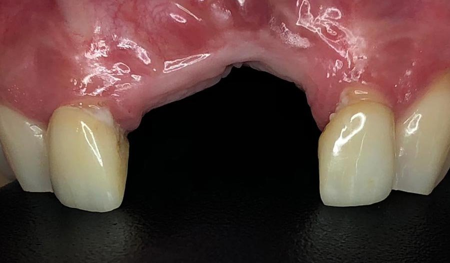 periodent-co-tijuana-dentist-dr-alejandra-gonzalez-before-after-dental-implant-case-03-2 periodent-co-tijuana-dentist-dr-alejandra-gonzalez-before-after-dental-implant-case-03-2