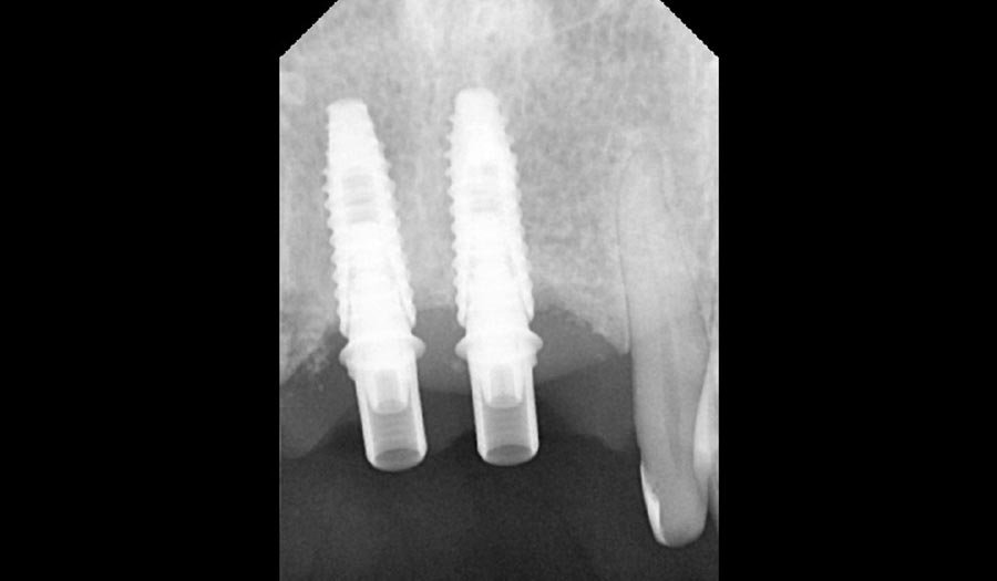 periodent-co-tijuana-dentist-dr-alejandra-gonzalez-before-after-dental-implant-case-03-3