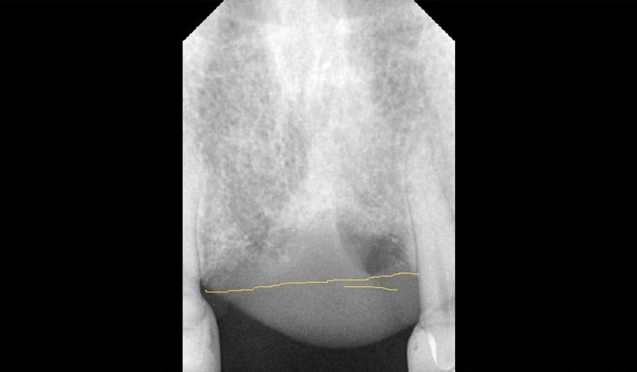 periodent-co-tijuana-dentist-dr-alejandra-gonzalez-before-after-dental-implant-case-03-4 periodent-co-tijuana-dentist-dr-alejandra-gonzalez-before-after-dental-implant-case-03-4