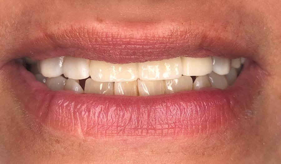 periodent-co-tijuana-dentist-dr-alejandra-gonzalez-before-after-dental-implant-case-04-1