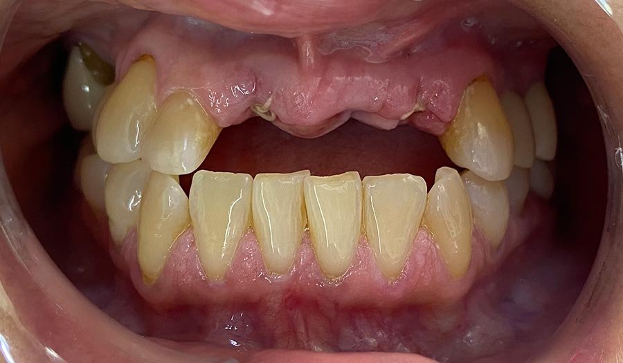 periodent-co-tijuana-dentist-dr-alejandra-gonzalez-before-after-dental-implant-case-04-2 periodent-co-tijuana-dentist-dr-alejandra-gonzalez-before-after-dental-implant-case-04-2