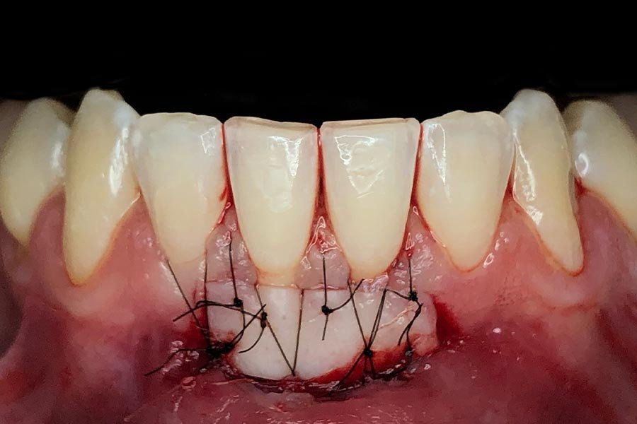 periodent-co-tijuana-dentist-dr-alejandra-gonzalez-before-after-periodontics-case-01-1