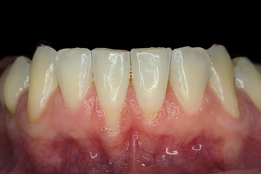 periodent-co-tijuana-dentist-dr-alejandra-gonzalez-before-after-periodontics-case-01-2 periodent-co-tijuana-dentist-dr-alejandra-gonzalez-before-after-periodontics-case-01-2