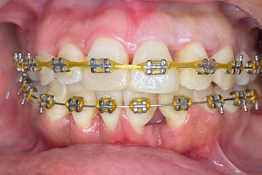 periodent-co-tijuana-dentist-dr-alejandra-gonzalez-before-after-periodontics-case-02-1