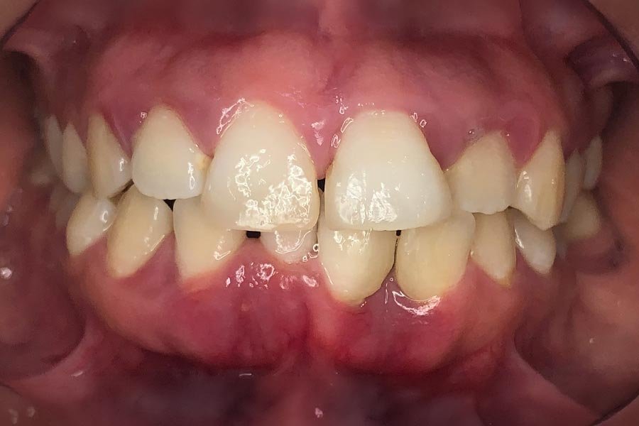 periodent-co-tijuana-dentist-dr-alejandra-gonzalez-before-after-periodontics-case-02-2 periodent-co-tijuana-dentist-dr-alejandra-gonzalez-before-after-periodontics-case-02-2