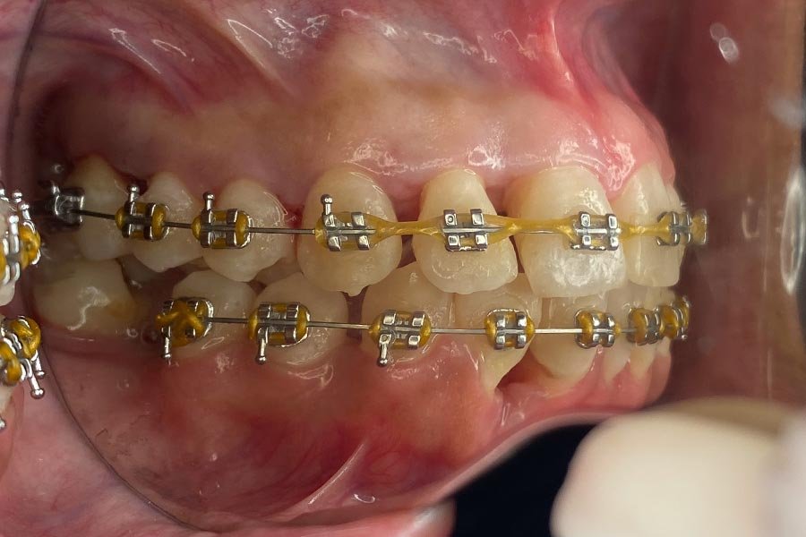 periodent-co-tijuana-dentist-dr-alejandra-gonzalez-before-after-periodontics-case-02-3