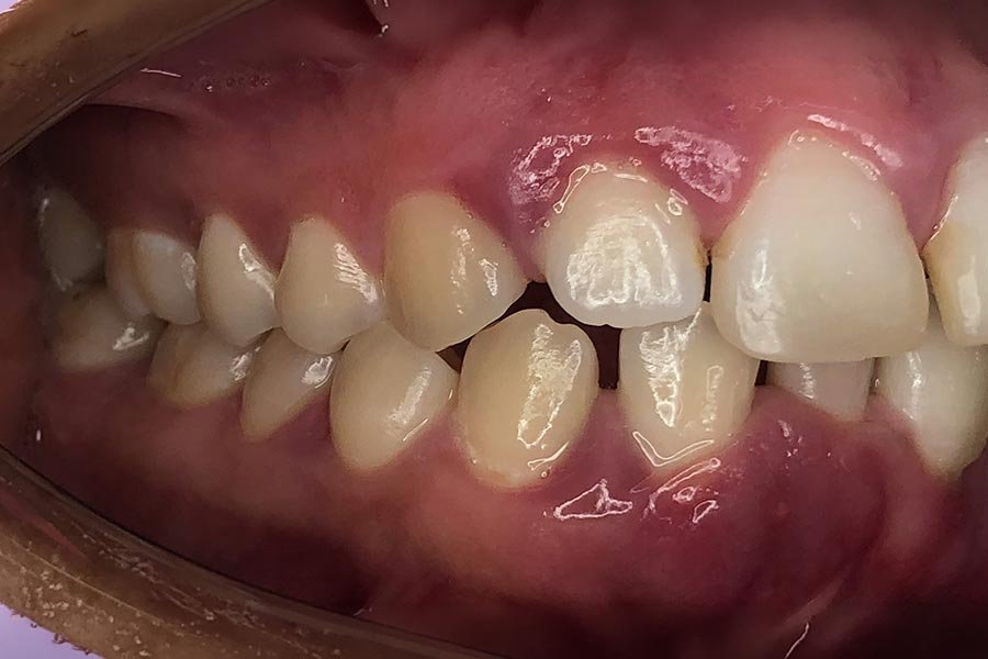periodent-co-tijuana-dentist-dr-alejandra-gonzalez-before-after-periodontics-case-02-4 periodent-co-tijuana-dentist-dr-alejandra-gonzalez-before-after-periodontics-case-02-4