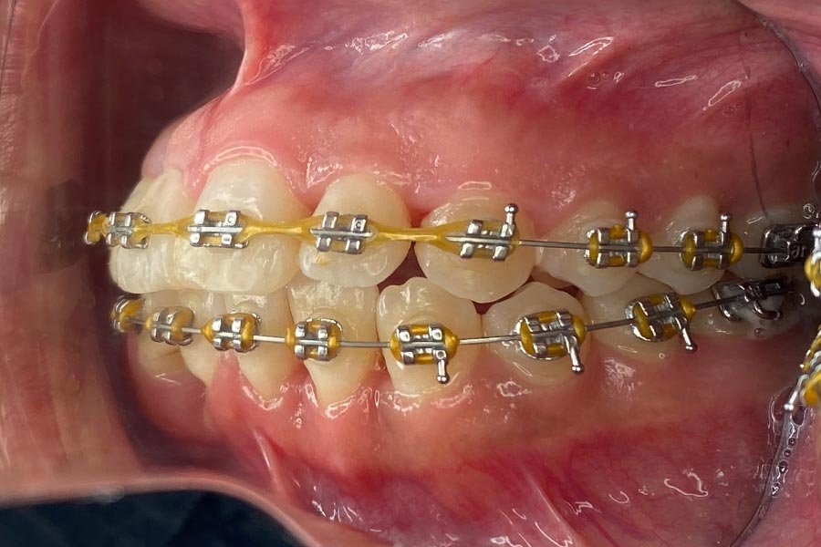 periodent-co-tijuana-dentist-dr-alejandra-gonzalez-before-after-periodontics-case-02-5