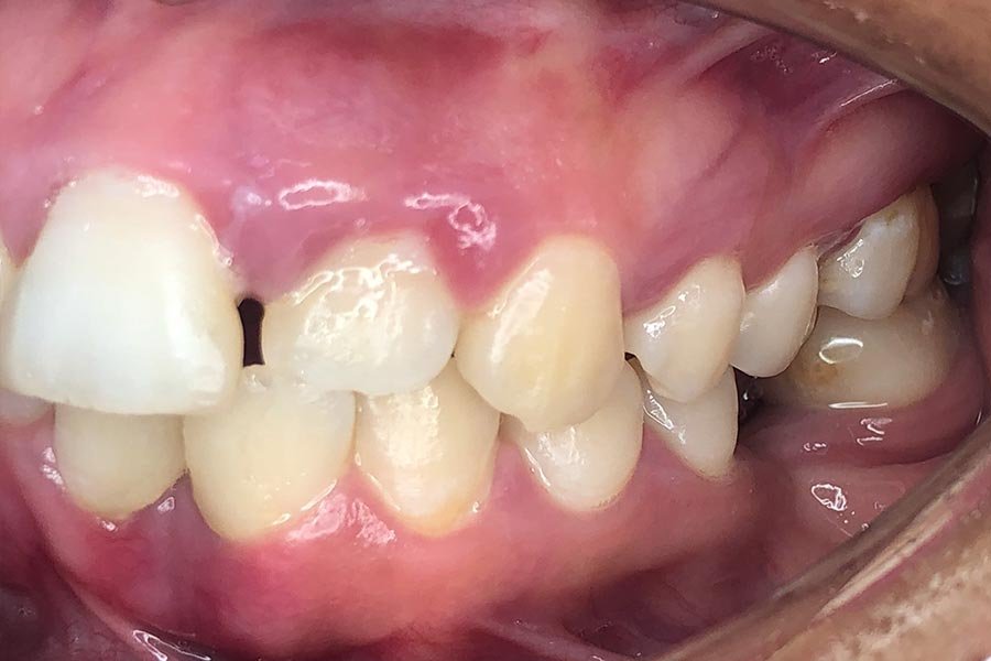 periodent-co-tijuana-dentist-dr-alejandra-gonzalez-before-after-periodontics-case-02-6 periodent-co-tijuana-dentist-dr-alejandra-gonzalez-before-after-periodontics-case-02-6