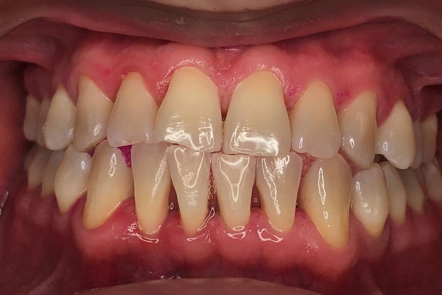periodent-co-tijuana-dentist-dr-alejandra-gonzalez-before-after-periodontics-case-03-1