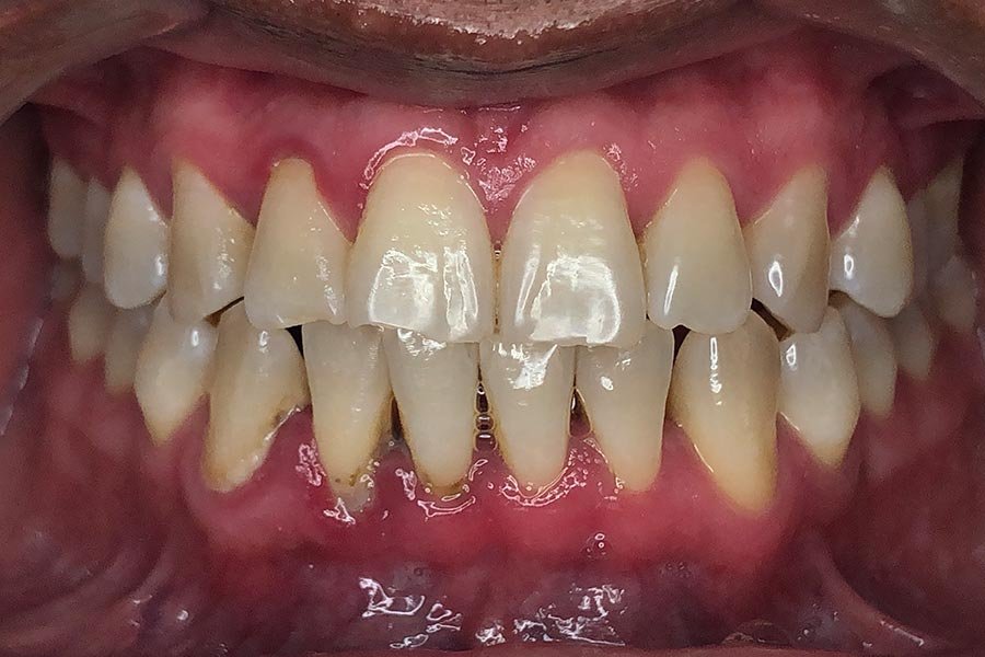 periodent-co-tijuana-dentist-dr-alejandra-gonzalez-before-after-periodontics-case-03-2 periodent-co-tijuana-dentist-dr-alejandra-gonzalez-before-after-periodontics-case-03-2