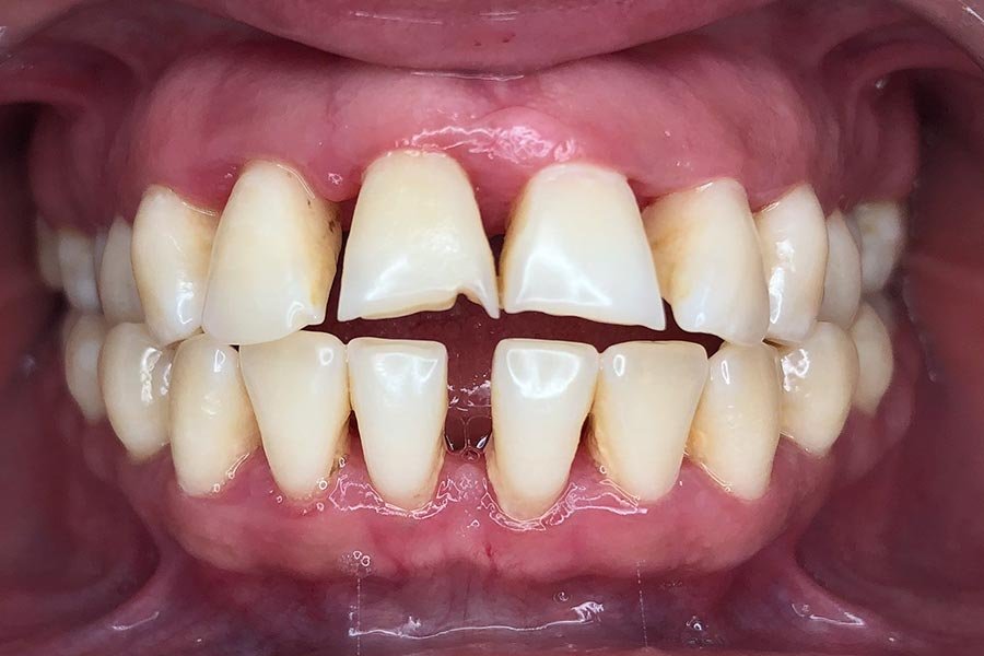 periodent-co-tijuana-dentist-dr-alejandra-gonzalez-before-after-periodontics-case-04-1