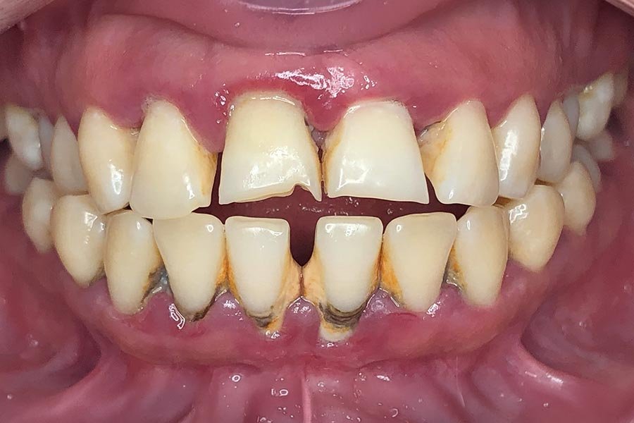 periodent-co-tijuana-dentist-dr-alejandra-gonzalez-before-after-periodontics-case-04-2 periodent-co-tijuana-dentist-dr-alejandra-gonzalez-before-after-periodontics-case-04-2