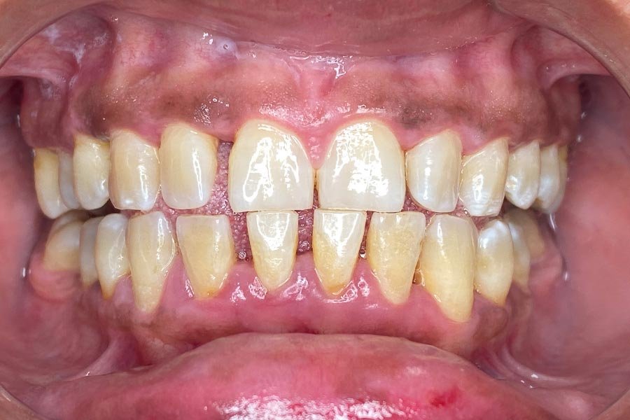 periodent-co-tijuana-dentist-dr-alejandra-gonzalez-before-after-periodontics-case-05-1