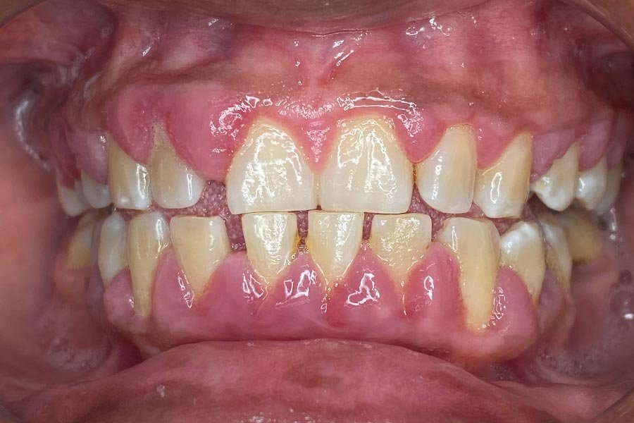 periodent-co-tijuana-dentist-dr-alejandra-gonzalez-before-after-periodontics-case-05-2 periodent-co-tijuana-dentist-dr-alejandra-gonzalez-before-after-periodontics-case-05-2
