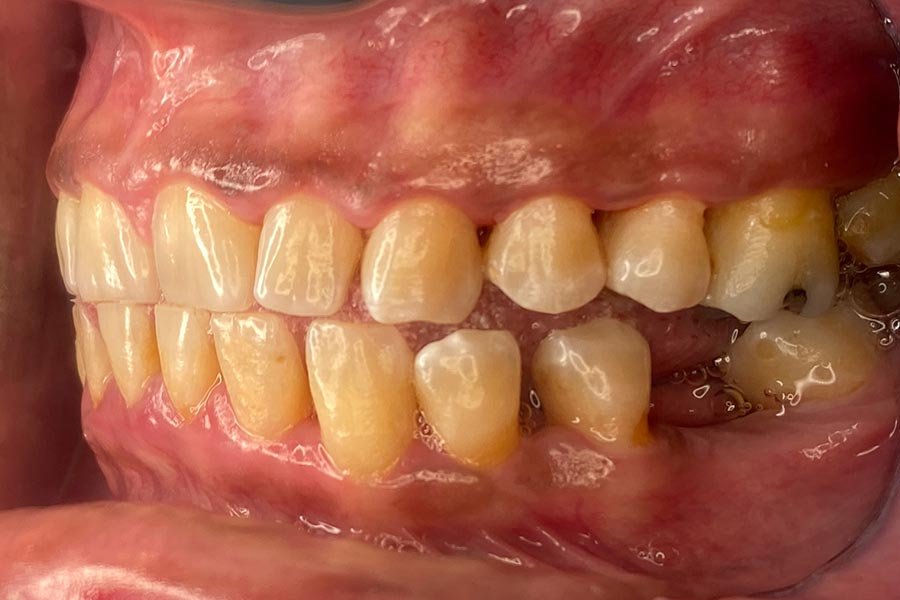 periodent-co-tijuana-dentist-dr-alejandra-gonzalez-before-after-periodontics-case-05-3