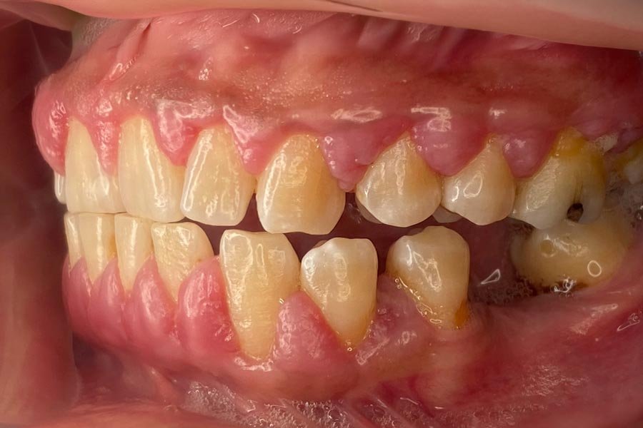 periodent-co-tijuana-dentist-dr-alejandra-gonzalez-before-after-periodontics-case-05-4 periodent-co-tijuana-dentist-dr-alejandra-gonzalez-before-after-periodontics-case-05-4