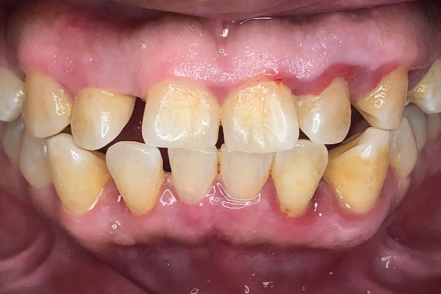 periodent-co-tijuana-dentist-dr-alejandra-gonzalez-before-after-periodontics-case-06-1