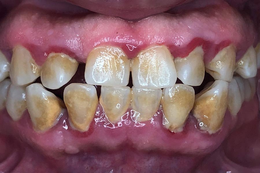 periodent-co-tijuana-dentist-dr-alejandra-gonzalez-before-after-periodontics-case-06-2 periodent-co-tijuana-dentist-dr-alejandra-gonzalez-before-after-periodontics-case-06-2